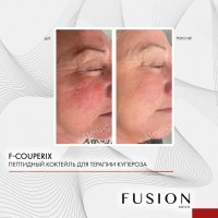 Fusion Mesotherapy F-Couperix (Venostim) (Коктейль на основе пептидов,факторов роста и органического кремния), 5 мл
