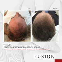 Fusion Mesotherapy F-HAIR (Комплекс для волос), 1 шт x10 мл