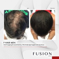 Fusion Mesotherapy F-HAIR MEN (Комплекс для волос), 1 шт x 5 мл