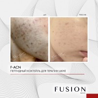 Fusion Mesotherapy F-ACN (Коктейль для лечения акне), 1 шт x 10 мл