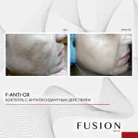 Fusion Mesotherapy F-ANTI-OX (Мезококтейль против фотостарения), 10 мл