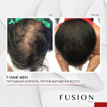F-HAIR MEN (Комплекс для волос), 1 шт x 5 мл