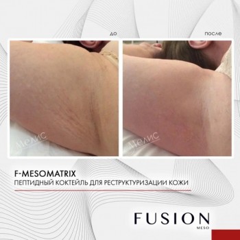 F-Mesomatrix (Коктейль для реструктуризации и регенерации кожи), 1 шт x 5 мл