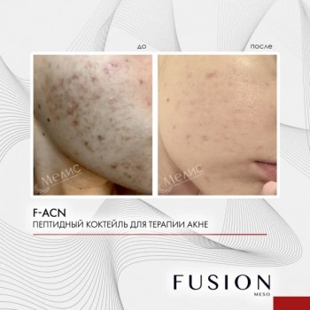 F-ACN (Коктейль для лечения акне), 1 шт x 10 мл